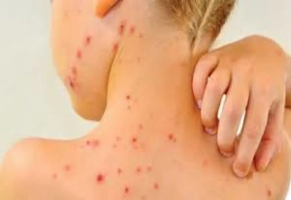 În plină epidemie de coronavirus, rujeola contină și ea să facă victime