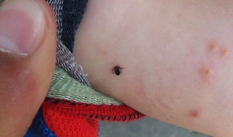 Ploieștean revoltat după ce copilul lui a fost mușcat de o căpușă: Domnule primar, cât să mai acceptăm ca ai noştri copii să fie muşcaţi de căpuşe?