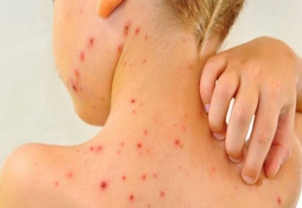 INSP: Aproape 400 de cazuri noi de rujeolă înregistrate în ultima săptămână